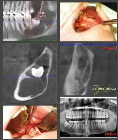 Investigații și tratament pentru un chist dentiger
