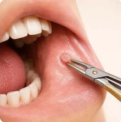 Prelevarea unei biopsii orale