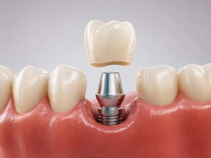 Aplicarea coroanei pe implantul dentar