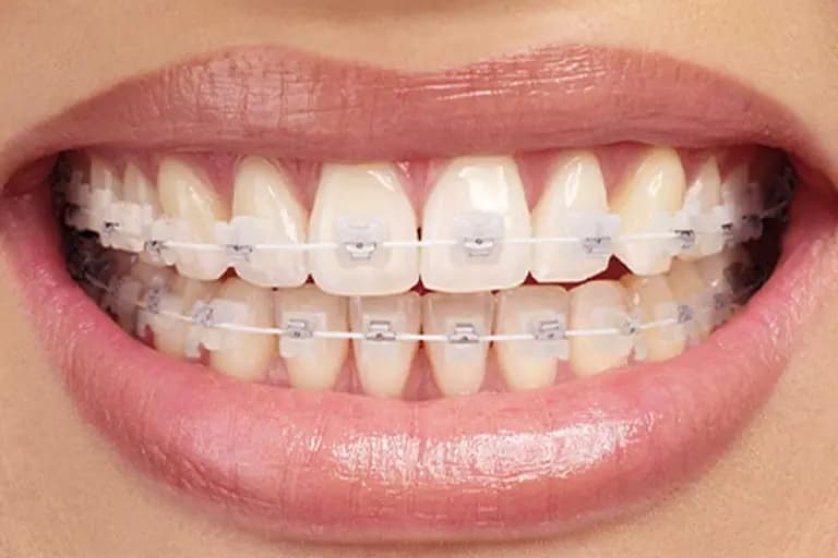 Aparat dentar cu brackets ceramici