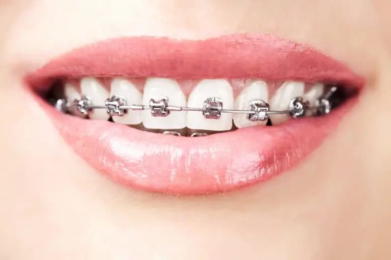 Aparat dentar cu brackets metalici