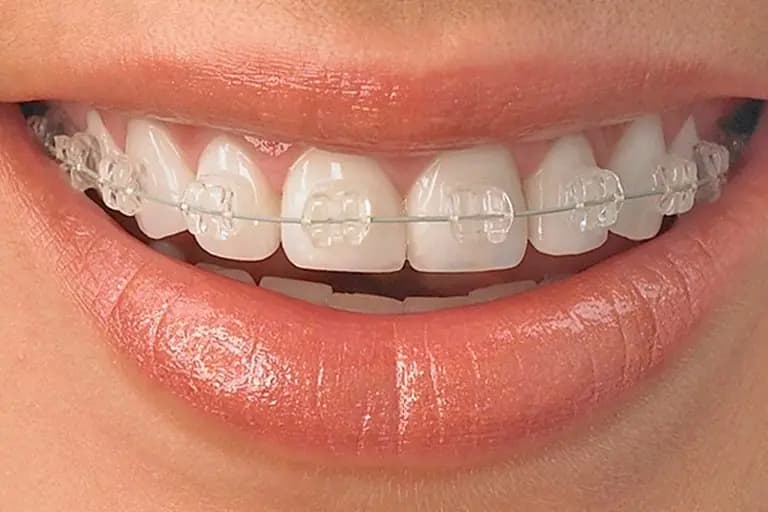 Aparat dentar cu brackets din safir